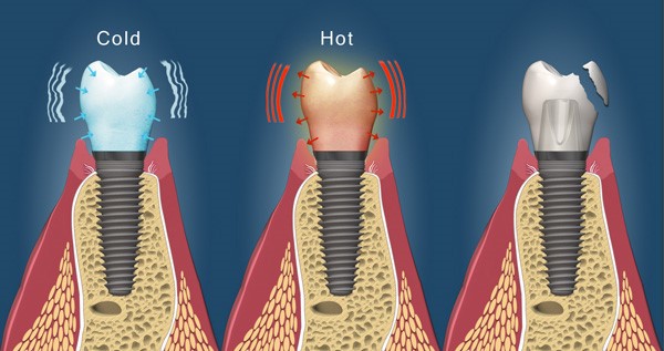 Take care of your dental implants