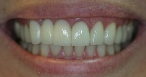 Patient's teeth after zirconia crowns