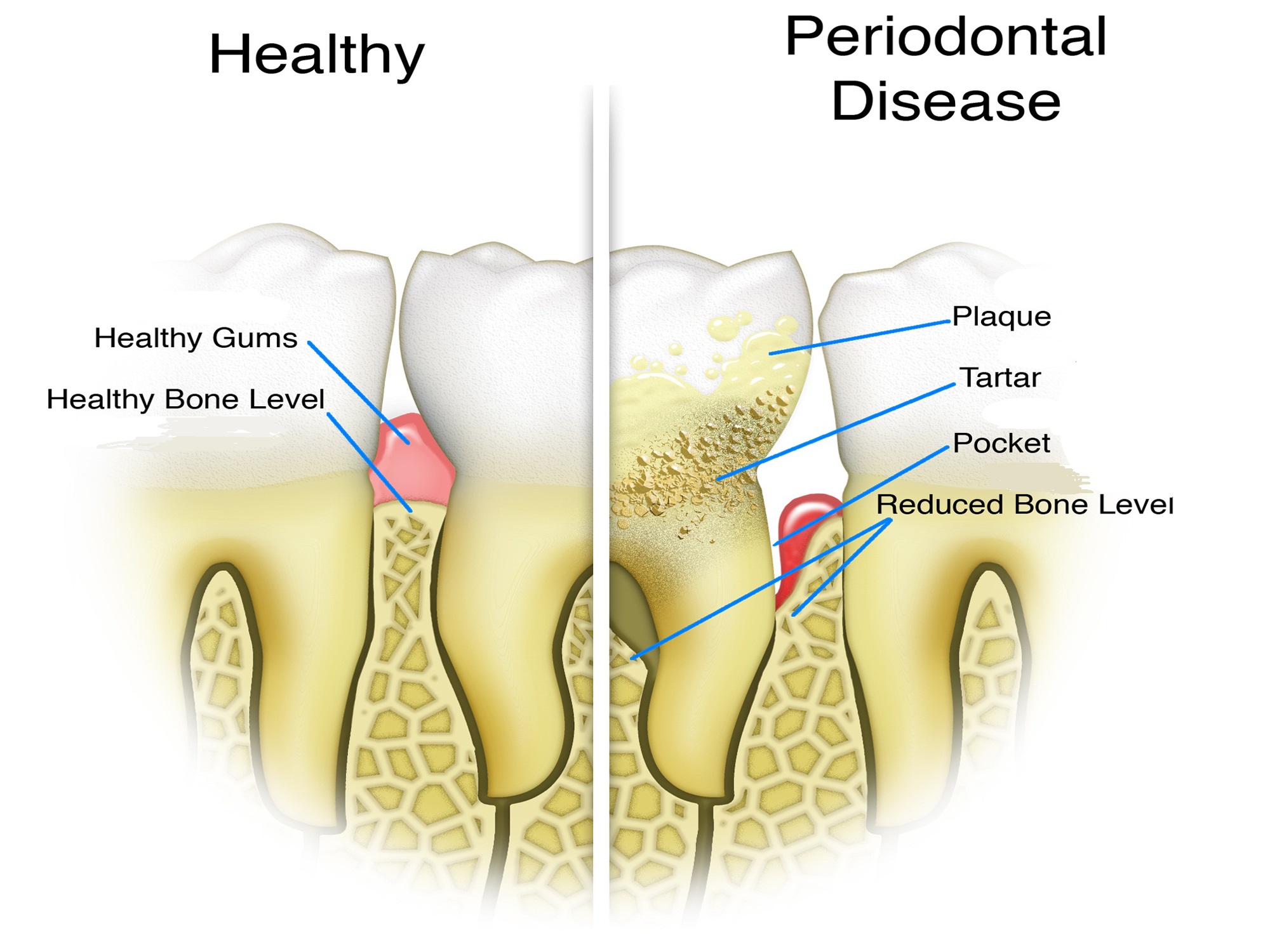 Aftercare bridges and crowns