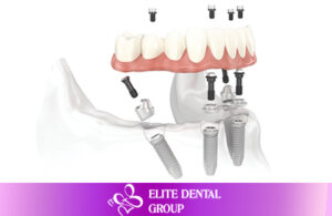 Dental implant All-on-4