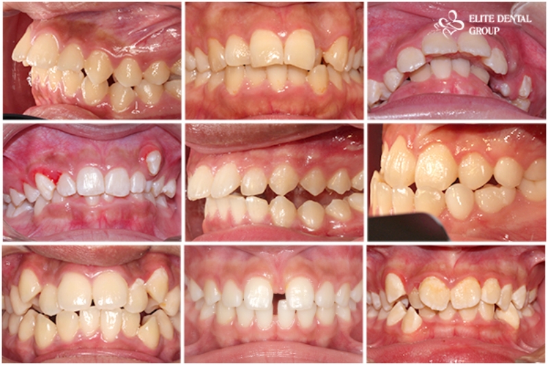 Orthodontic Braces: Types & How do they work?