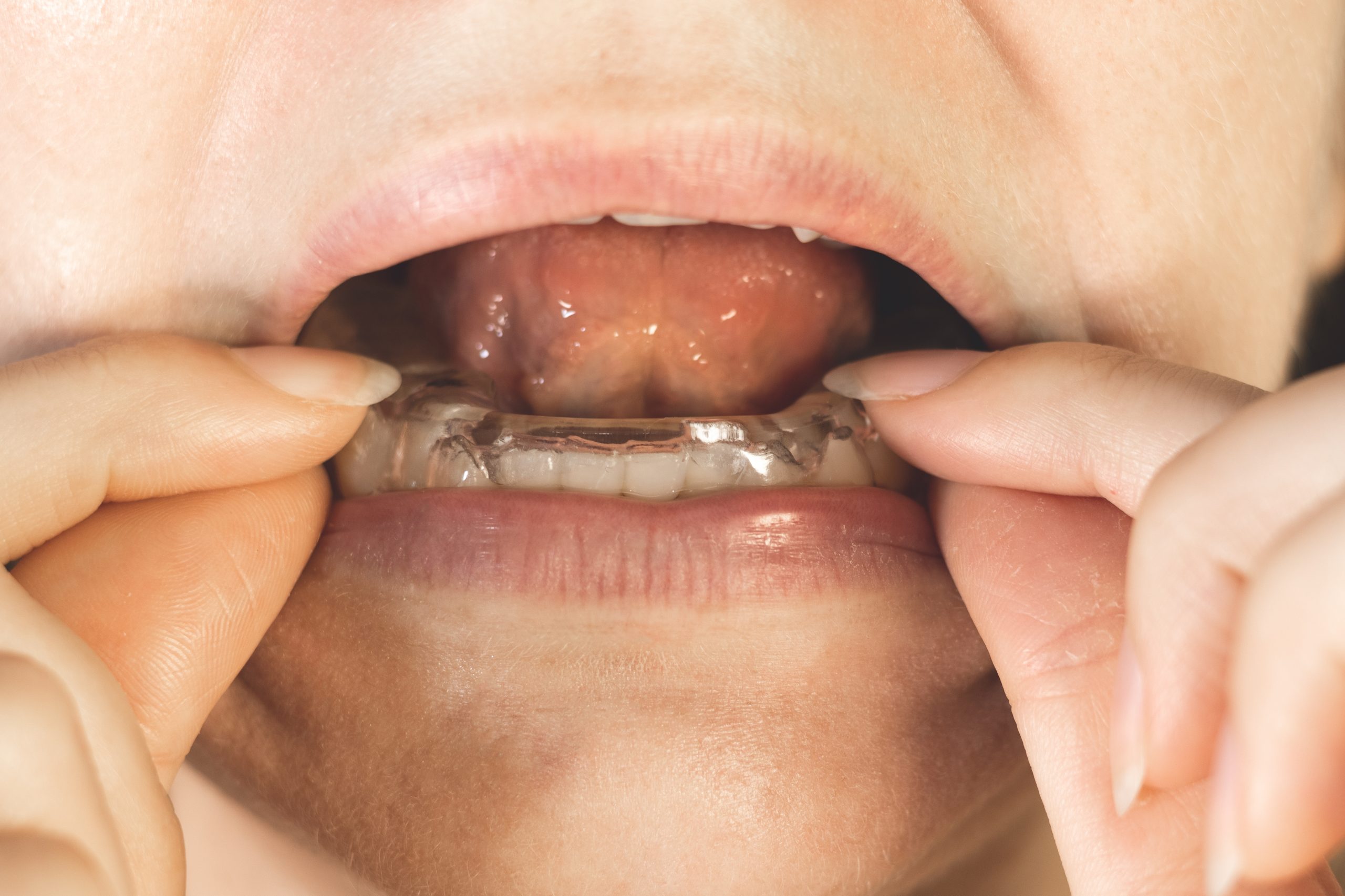 Splints prevent the upper and lower teeth from coming together.