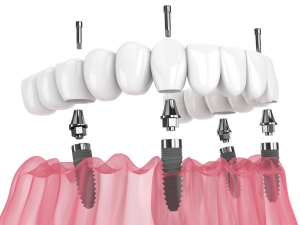 Can Dental Implants Be Done In A Day?