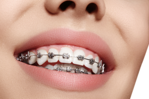 How to fix underbite teeth with braces?