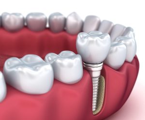 Dental Implants procedure