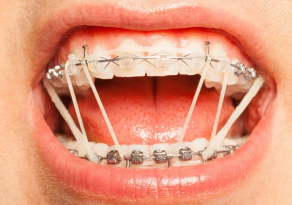 How To Manage Rubber Bands and Braces Pain
