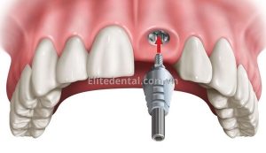 Front dental implant