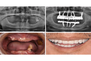 Full mouth dental implants