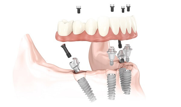 Dental Implant