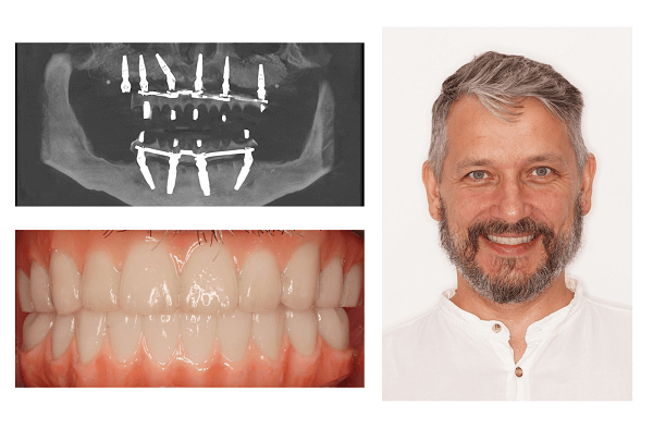 The image after undergoing full-arch implant treatment with All on 6 for the upper jaw and All on 4 for the lower jaw