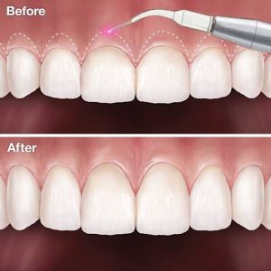 gum contouring surgery