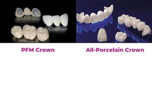 metal crown vs ceramic