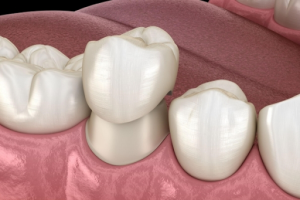 dental crown cost