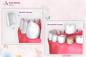 cost veneers vs crowns