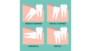 wisdom teeth function