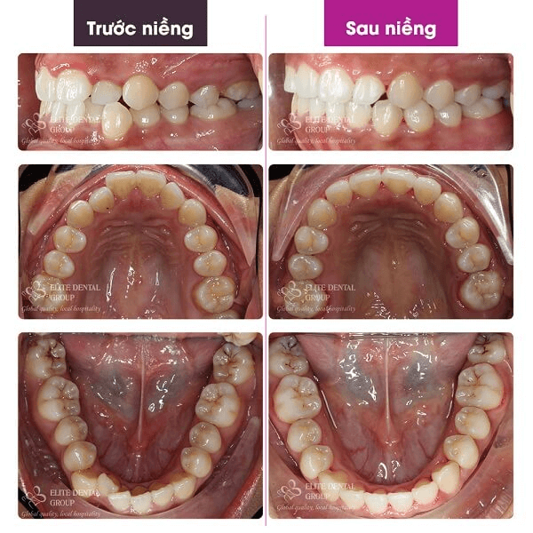 bao-chau-treatment-result