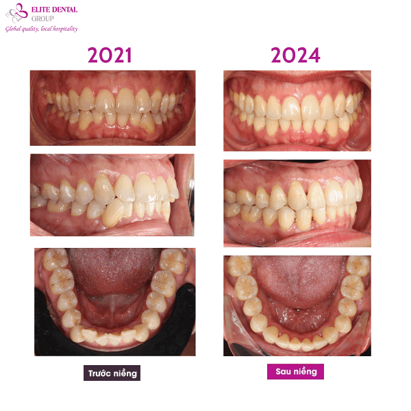 bt-treatment-result