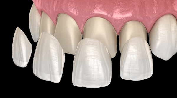 Porcelain veneers are an aesthetic restoration method that can improve many tooth defects such as discoloration, uneven teeth, etc.