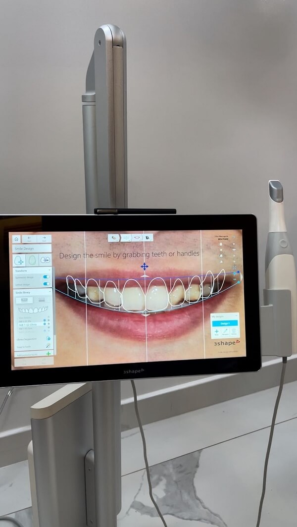 The doctor uses smile design software to see the results of treatment beforehand