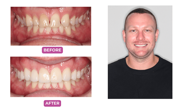 Before-and-after images of Mr. Luke's porcelain veneer procedure