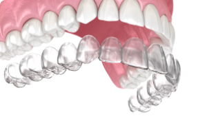 Clear aligners service