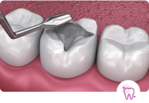 Cosmetic tooth filling service