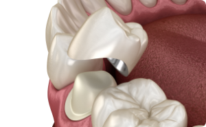 dental crowns ceramic service