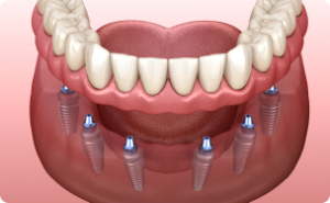 Full-arch Implant Service