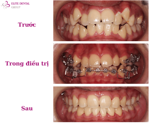 Khang Huy treatment result