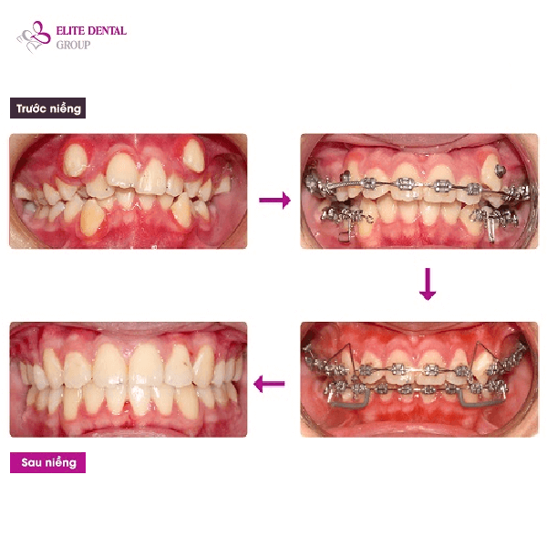 minh-thu-treatment-result