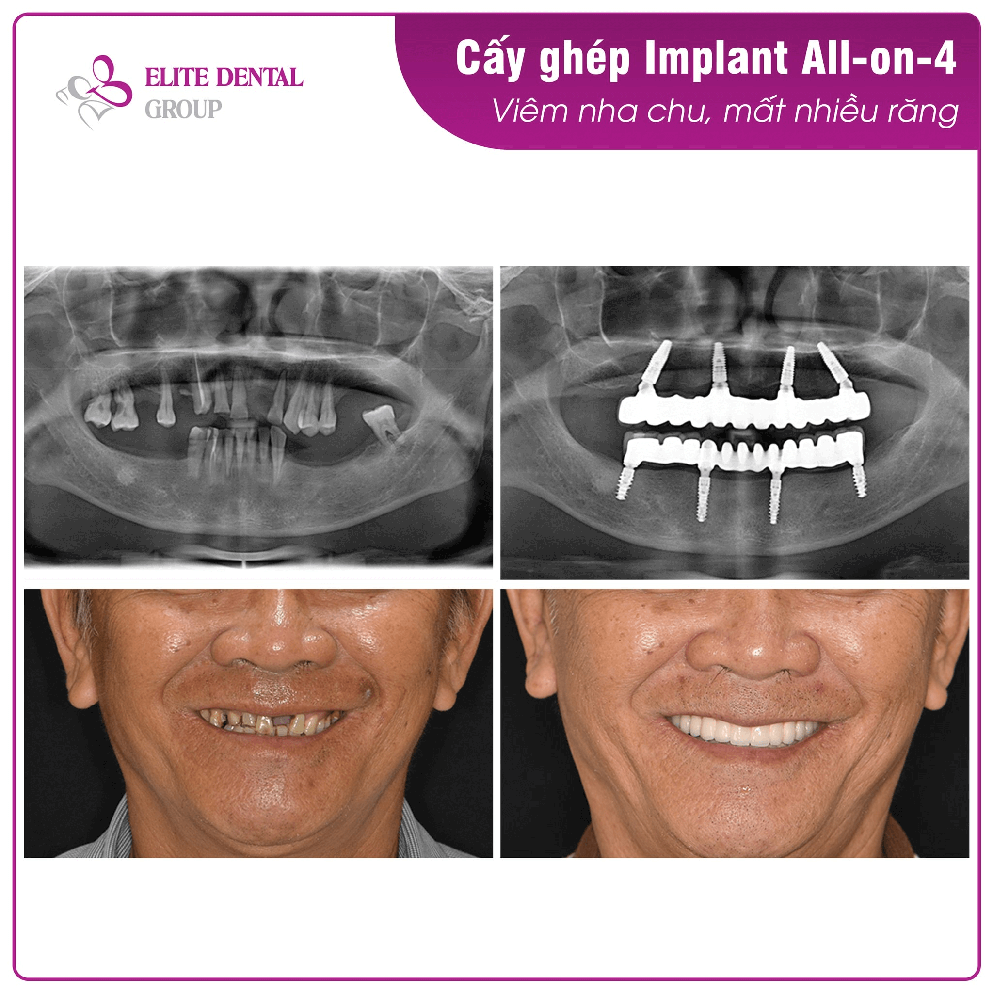 mr-d-treatment-result