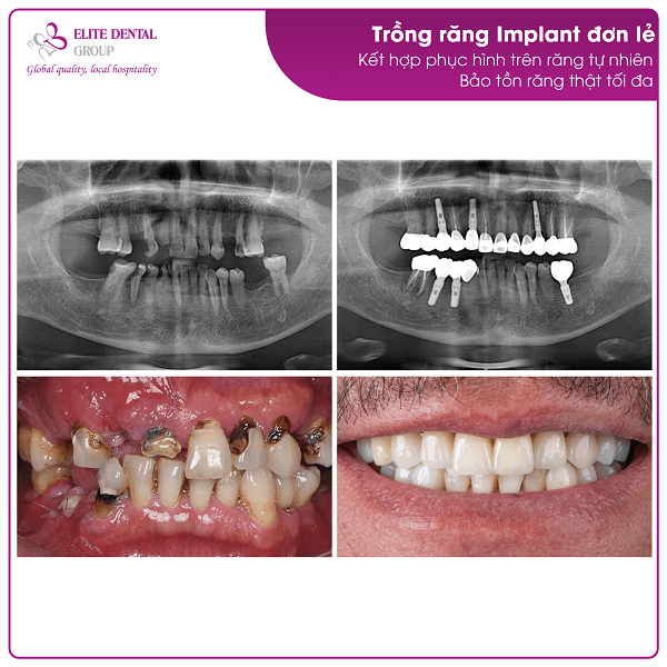 mr-nguyen-van-thang-treatment-result