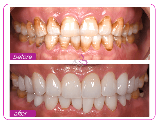 ms-h-treatment-result