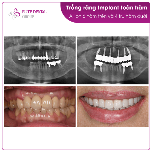 ms-lily-tran-treatment-result