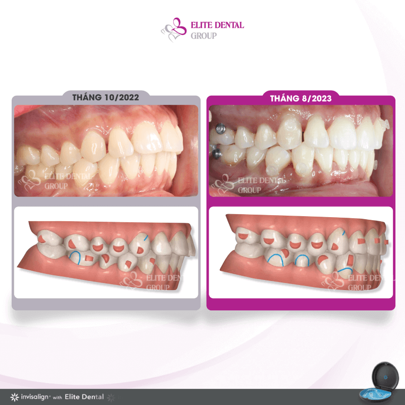 ms-lt-treatment-result