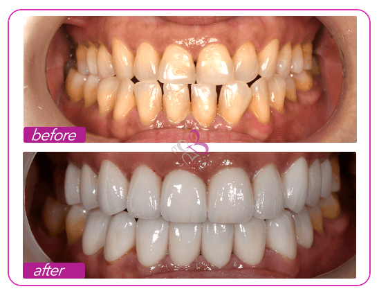 ms-m-treatment-result