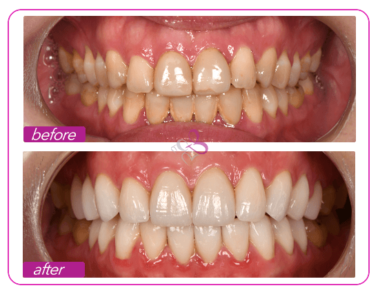 ms-q-treatment-result