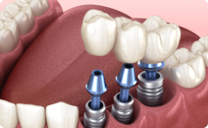 Multiple-tooth Implant Service