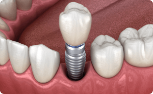 Single-tooth Implant Service