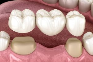 dental bridge front teeth