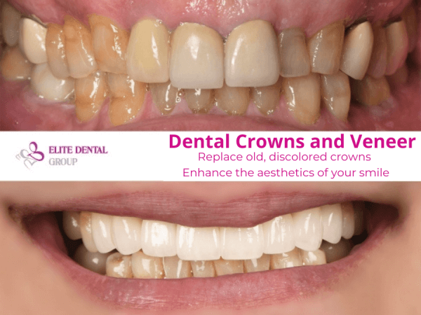 dental crowns