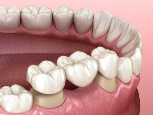 fixed implant dentures