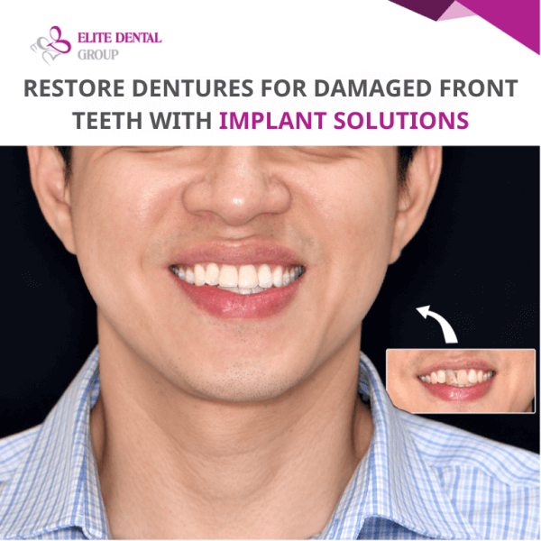 Implant front teeth