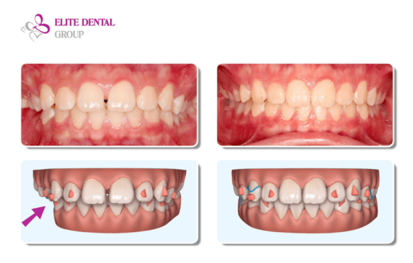 misaligned jaw before and after