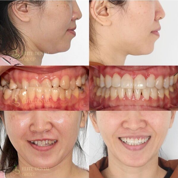 malocclusion symptoms