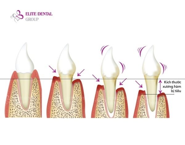 Bone loss progresses slowly, and by the time it is detected, the level of bone loss is already more severe.