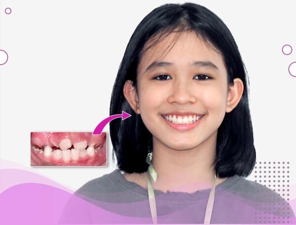 Comprehensive orthodontic results for children