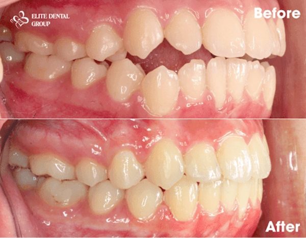 Correcting Open Bite