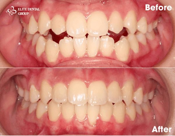 After undergoing open bite and overbite treatment with Invisalign braces, 18-year-old girl was very happy because she felt more beautiful and confident with her perfect smile.