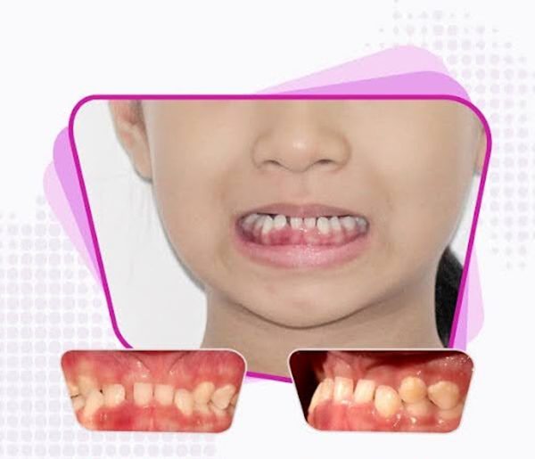 Underbite is one type of malocclusion